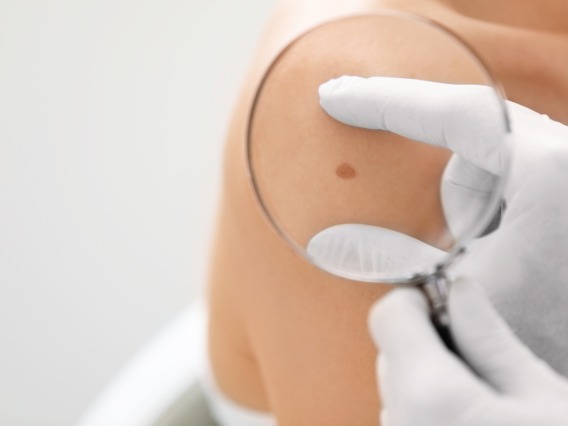 close up of a mole on a person's shoulder