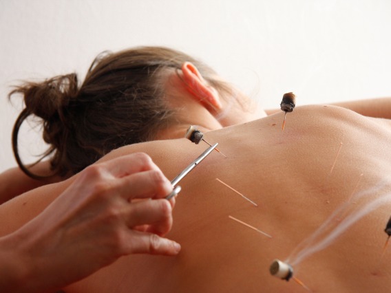 woman receiving acupuncture